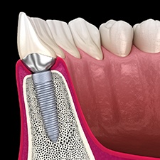 diagram showing bone surrounding the dental implant